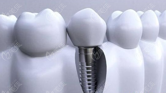 韩国登腾种植牙质量怎么样？