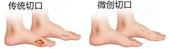 重庆骑士医院拇外翻（大脚骨）微创手术价格