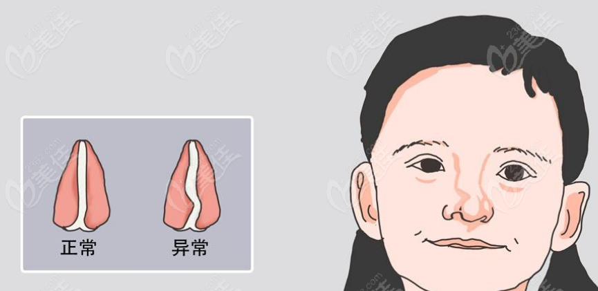 上海范锴做唇裂鼻畸形修复怎么样