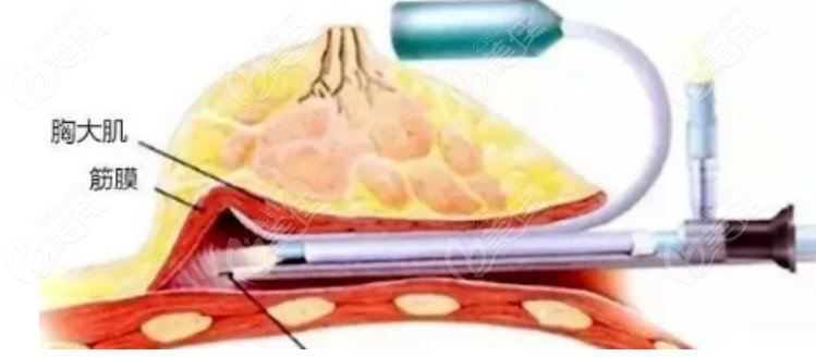 假體隆胸236z.com 假體隆胸236z.com
