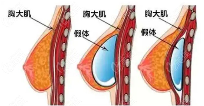 隆胸示意圖 隆胸示意圖