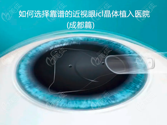 成都做晶体植入近视手术哪家医院医生好