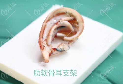 余文林耳再造實例