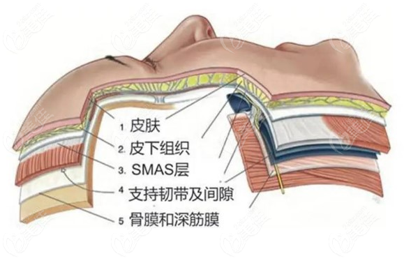 广州陈兵做拉皮手术操作更精细