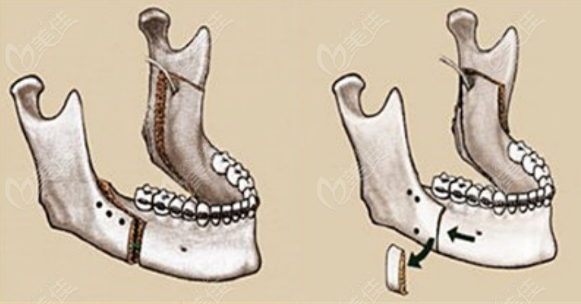 正颌手术示意图