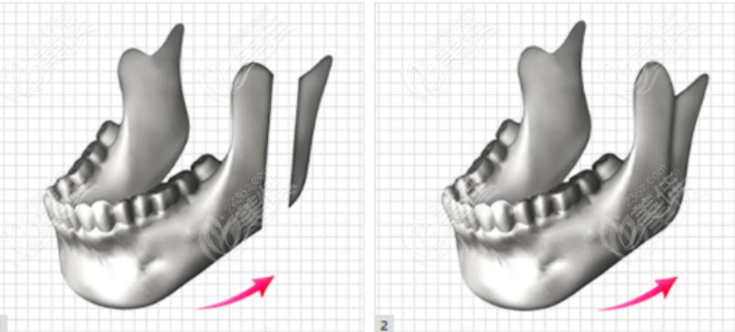 236z.com正颌手术示意图