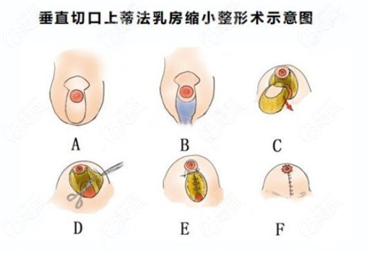 栗勇縮胸手術(shù)多久恢復(fù)www.236z.com