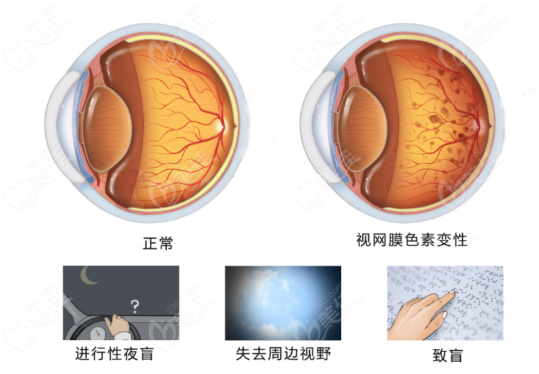 视网膜色素变性的对比