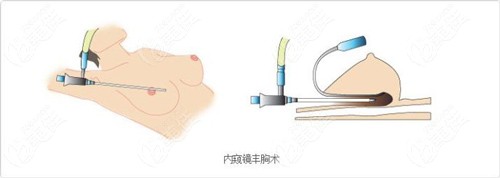 许扬滨医生做隆胸手术的原理图