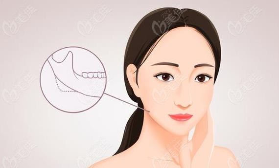 何照華下頜角切的太狠了是真的嗎