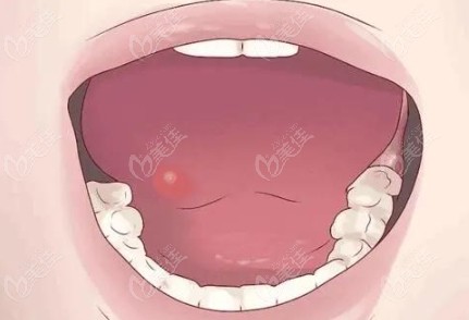 口腔白斑的治疗方法www.236z.com