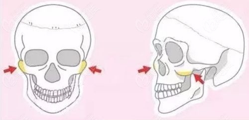 刘正茂医生做颧骨内推手术评价