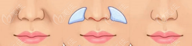鼻基底填充过程