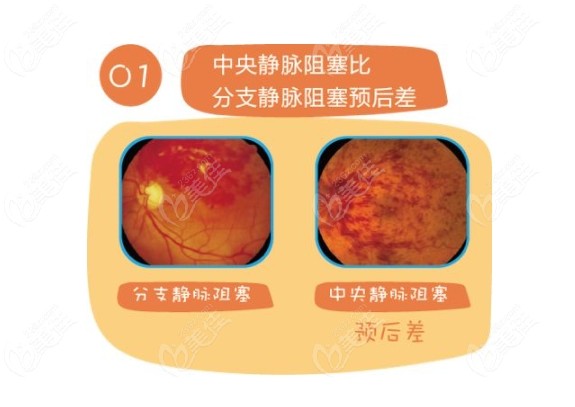 眼睛静脉阻塞