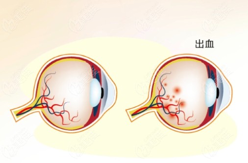 眼睛静脉阻塞出血www.236z.com