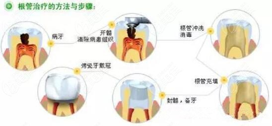 沈阳<!--<i data=20240703-sp></i>-->腔医院根管治疗收费m.236z.com