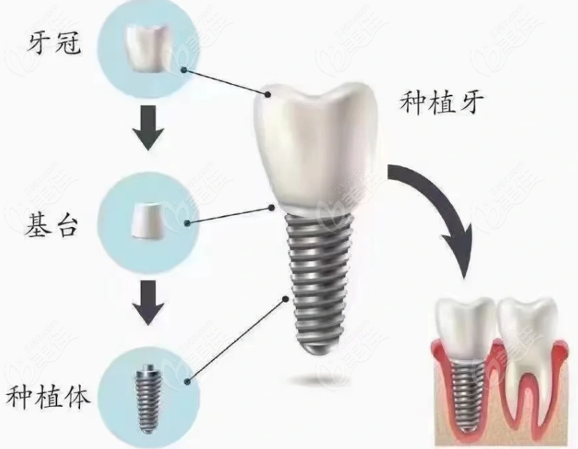 <!--<i data=20240703-sp></i>-->博义口腔种植牙技术和价格