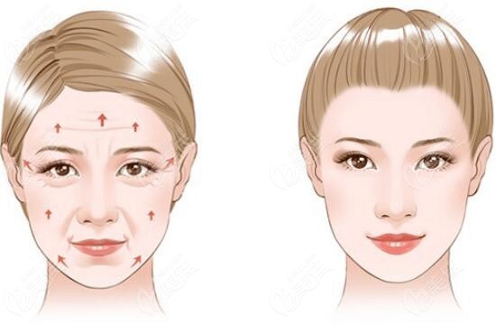 面部除皱做筋膜提升和v美减龄v6拉皮手术哪个好