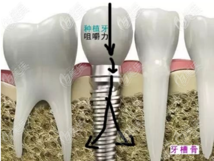 种植牙手术示意图