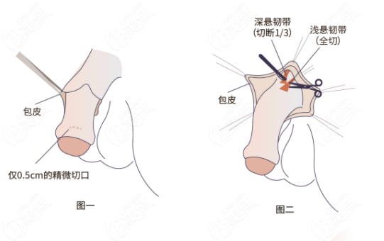 李世荣做隐痕阴茎延长增粗术优势