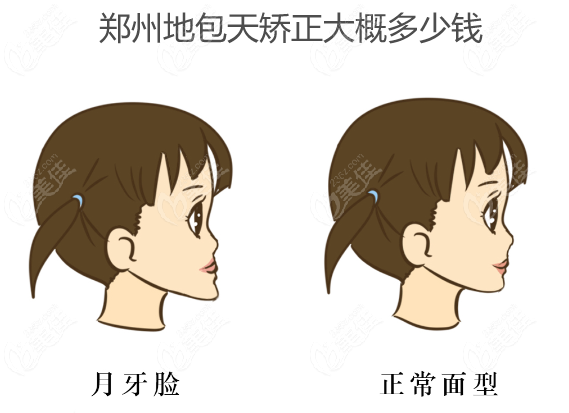 鄭州地包天矯正多少錢www.236z.com