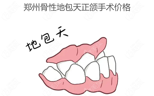 鄭州骨性地包天正頜手術費用