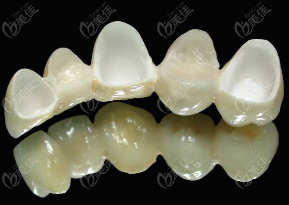 全瓷国产牙冠和进口牙冠有什么区别www.236z.com