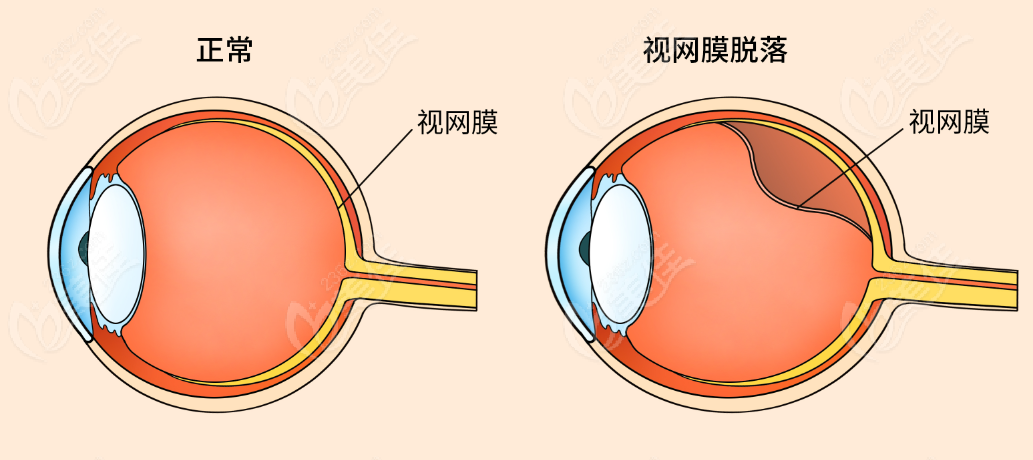 視網膜脫落情況對比