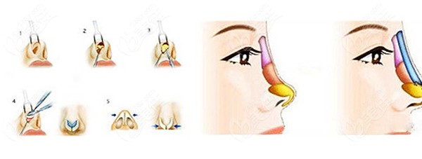 李喆医生做鼻修复手术的原理图www.236z.com
