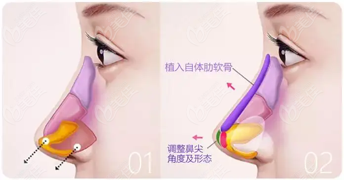 重庆李喆医生做鼻子会比较精细的调整