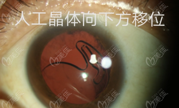 人工晶體偏移的眼睛