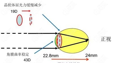 角膜曲率看k1还是k2高一定是圆锥角膜吗