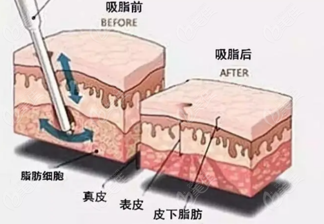 北京协和医院整形美容外科吸脂
