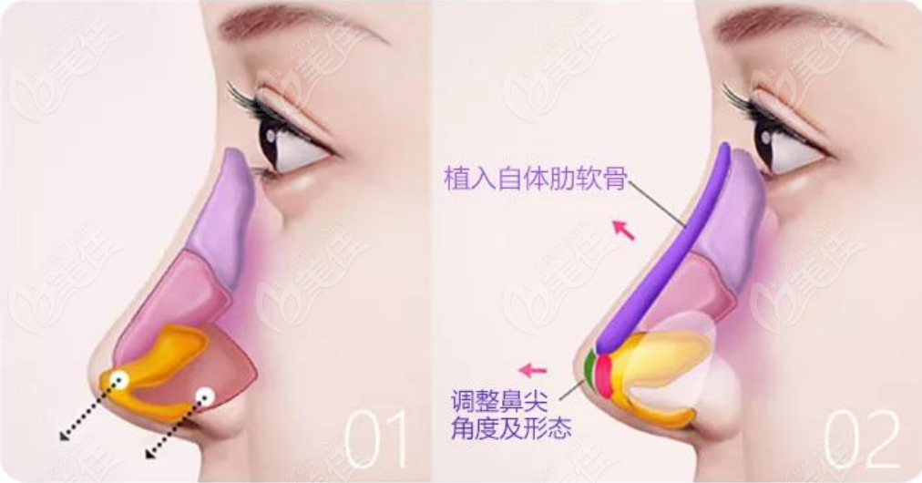 北京协和医院整形美容外科隆鼻