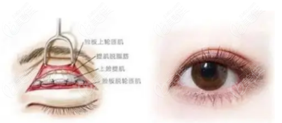 北京协和医院整形美容外科双眼皮