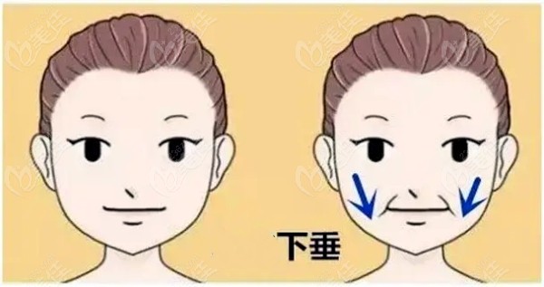缩脂针和下颌缘提升的区别