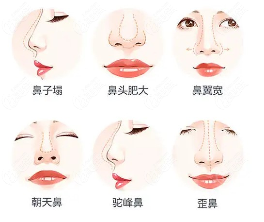 <!--<i data=20240703-sp></i>-->做鼻综合怎么样