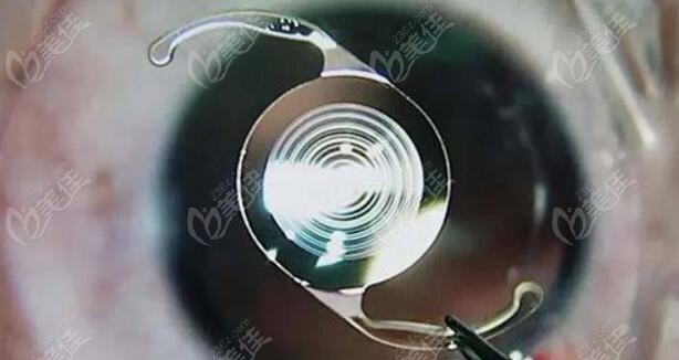 做近视手术之后和正常眼睛一样吗？