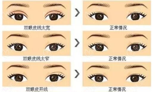 <!--<i data=20240703-sp></i>-->医生做双眼皮修复优势