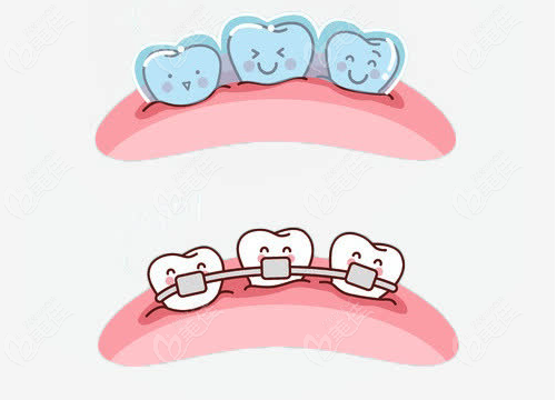 隐形牙齿矫正和钢丝牙套 优缺点对比www.236z.com