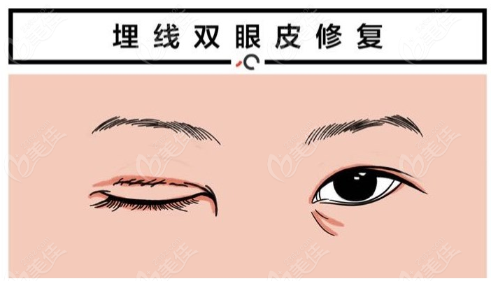 林靖修复眼睛咋样