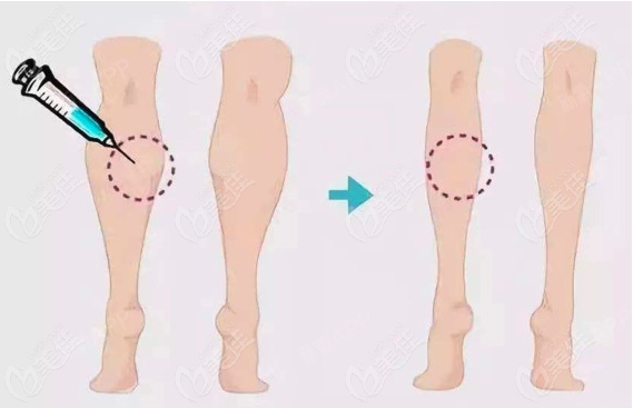 小腿吸脂如何做手术