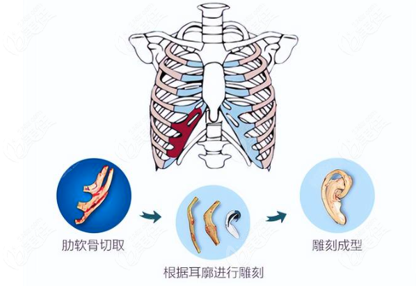 耳再造取材哪種好