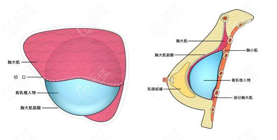 刘巍医生采用双平面的方式做隆胸手术
