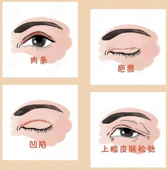 孟強(qiáng)醫(yī)生雙眼皮修復(fù)啥價(jià)格
