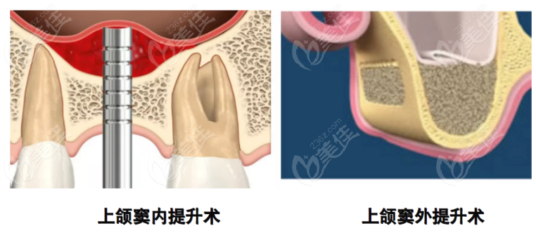 外提內提對比