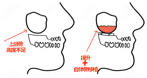 上頜骨提升