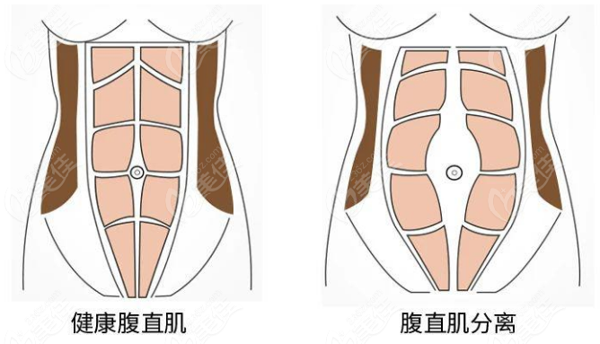 黄广香腹壁成形术的范例