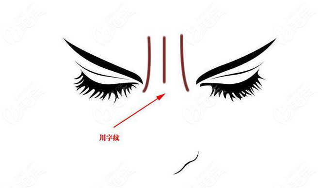 北京<!--<i data=20240703-sp></i>--><!--<i data=20240703-sp></i>-->李广学怎么去川字纹? 北京<!--<i data=20240703-sp></i>--><!--<i data=20240703-sp></i>-->李广学怎么去川字纹?