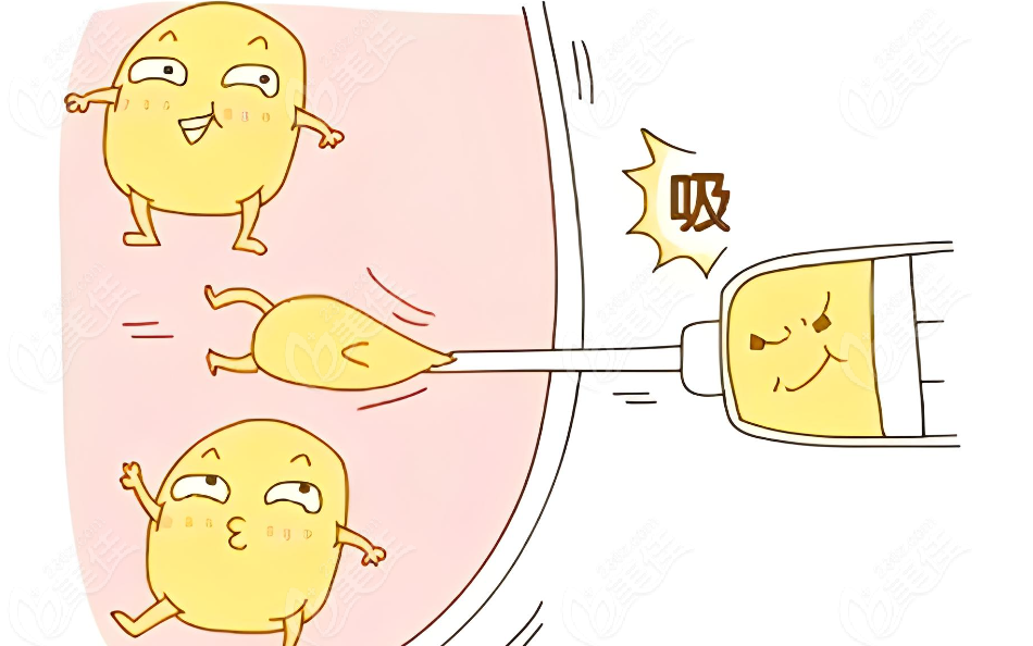 吸脂示意圖